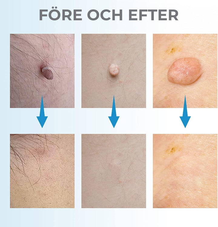 Natural skin imperfection remover kit. Effective at-home treatment for skin tags, warts & seborrheic keratosis.