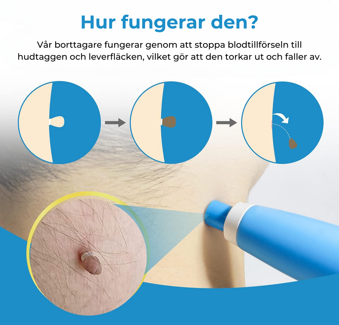 Beauty tool: At-home kit for skin tag, wart, and blemish removal. Promotes clear skin health & complexion.