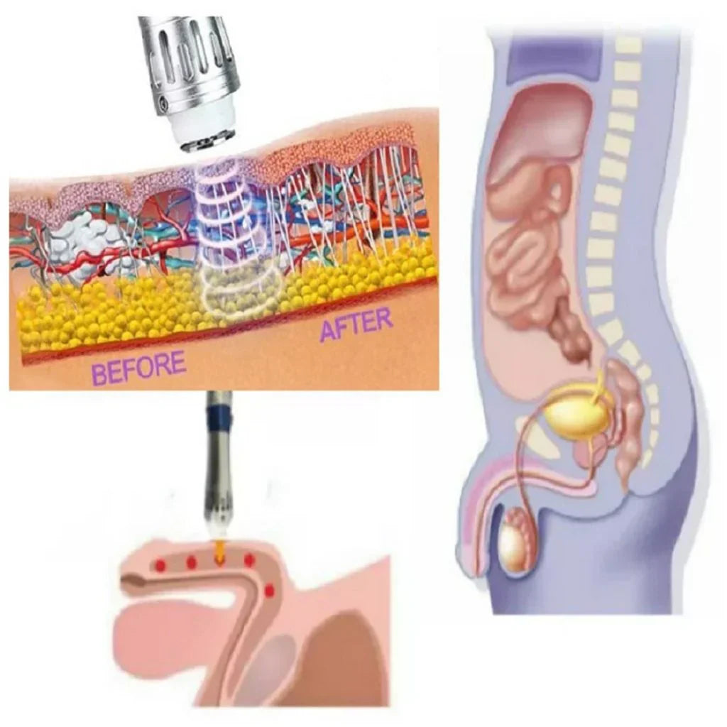 Non-invasive ED therapy device for men. Portable shockwave technology for improved sexual health.
