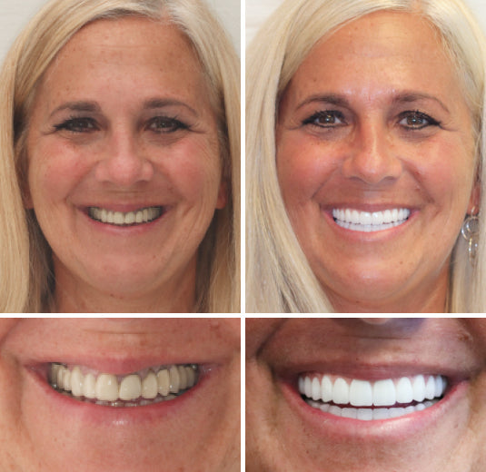 Durable unisex full dentures, custom designed for optimal comfort & a natural-looking ivory & white smile.