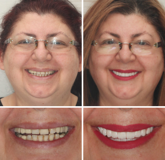 Cosmetic full dentures, custom crafted for a natural smile. Durable prosthetic with ivory & white shades.