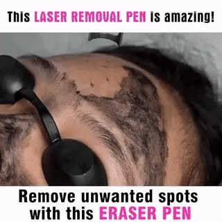 Compact picosecond laser pen for effective at-home tattoo removal & skin pigment correction.