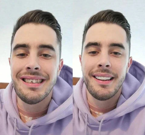 Realistic white snap-on cosmetic teeth veneers for a perfect, confident natural smile.